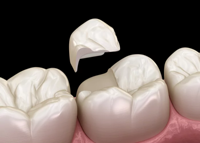 Endodontic Procedures